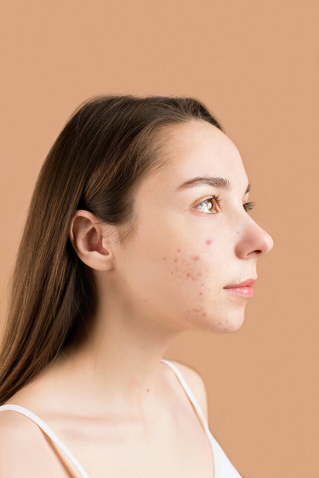 Acne